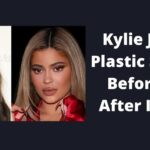 Kylie Jenner Before and After Plastic Surgery Photos