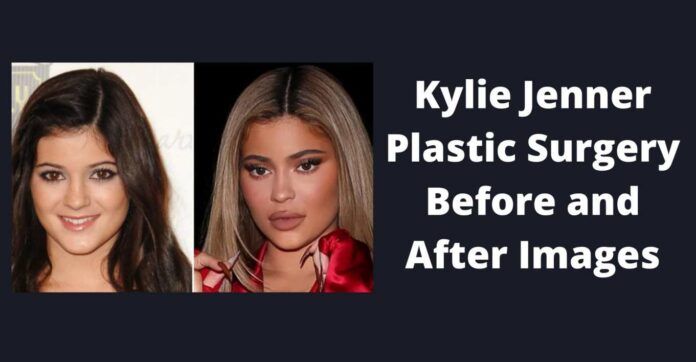 Kylie Jenner Before and After Plastic Surgery Photos