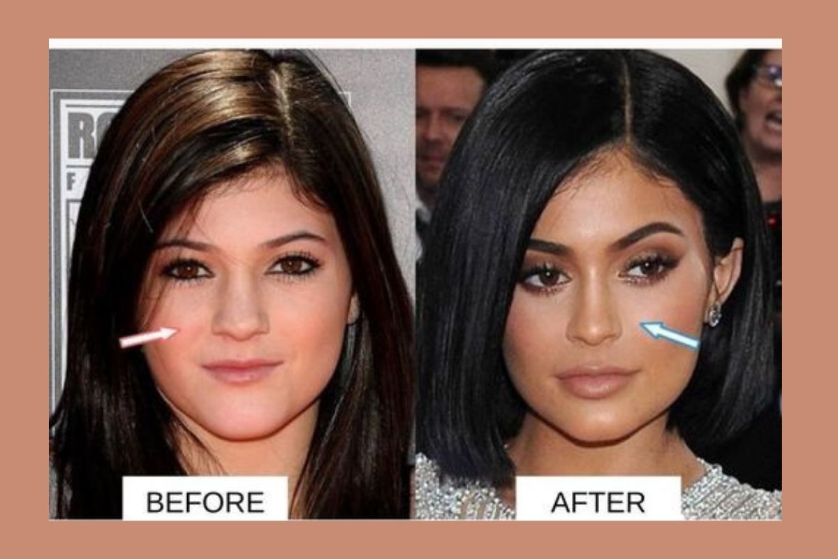 Kylie Jenner's Nose job