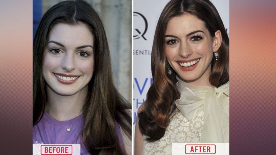 Anne Hathaway Lips Surgery