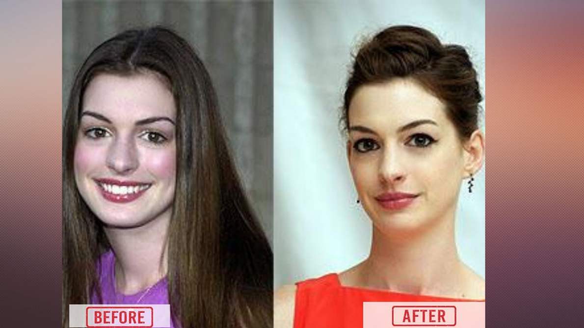 Anne Hathaway Nose Surgery.