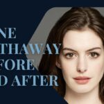 anne hathaway before and after Plastic Surgery