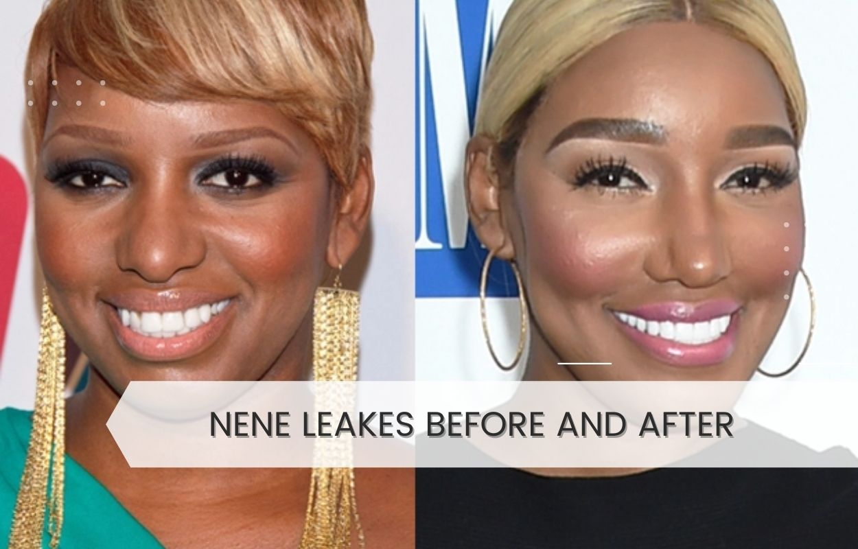 nene leakes before and after