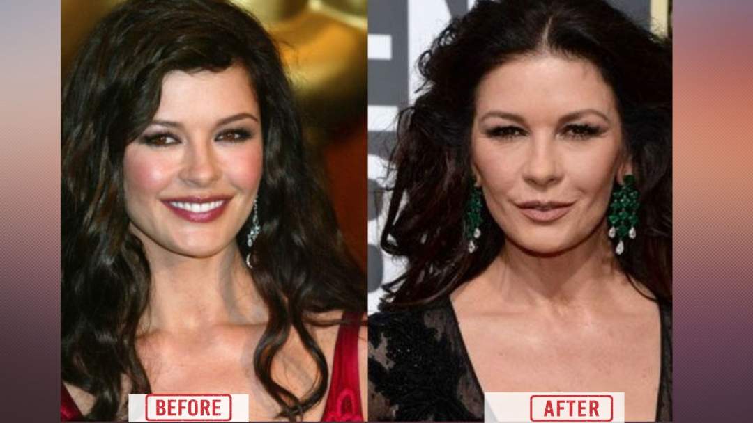 Catherine Zeta Before & after surgery