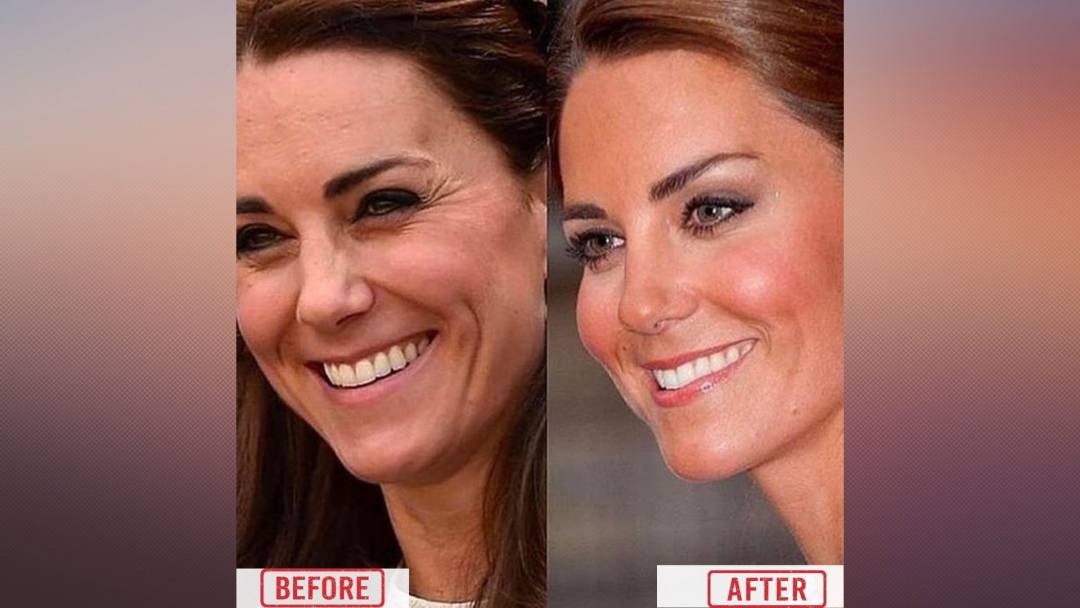 Kate Middleton botox