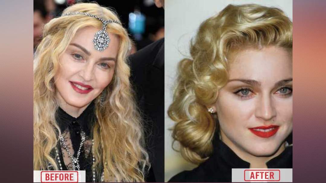 Madonna Cosmetic Surgery