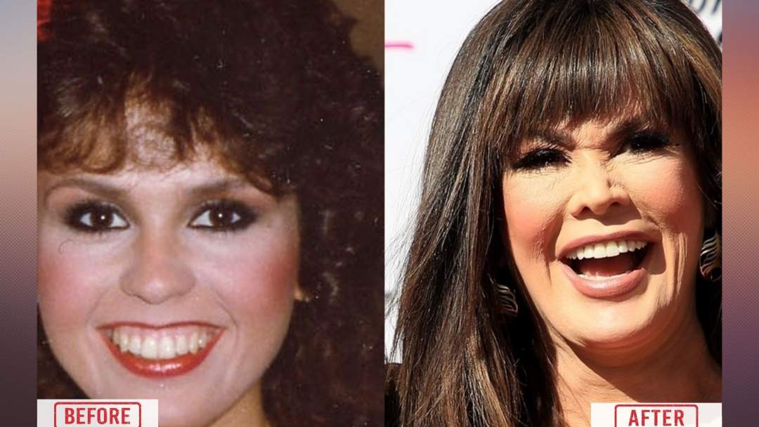 Marie Osmond Before & After