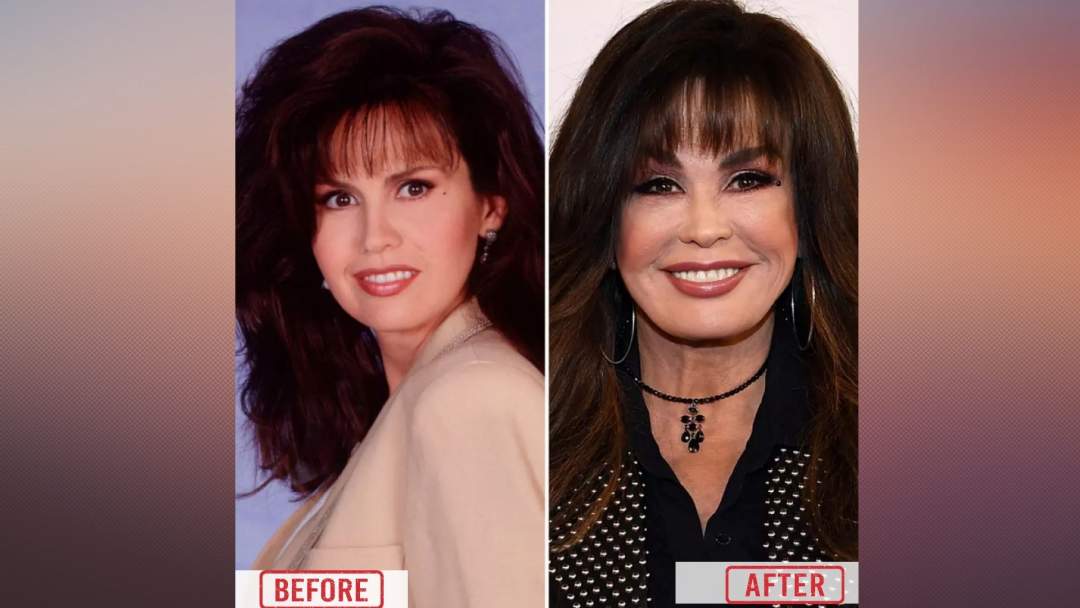 Marie Osmond Before & after image