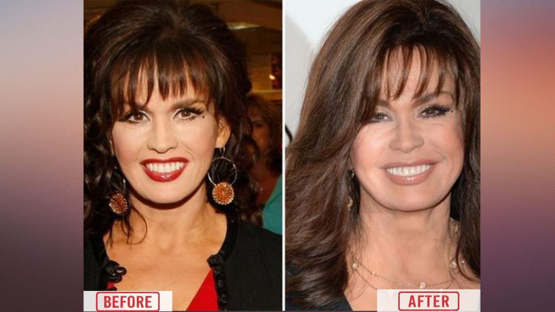 Marie Osmond Before & after surgery