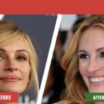 Julia Roberts Face Plastic Surgery Before And After