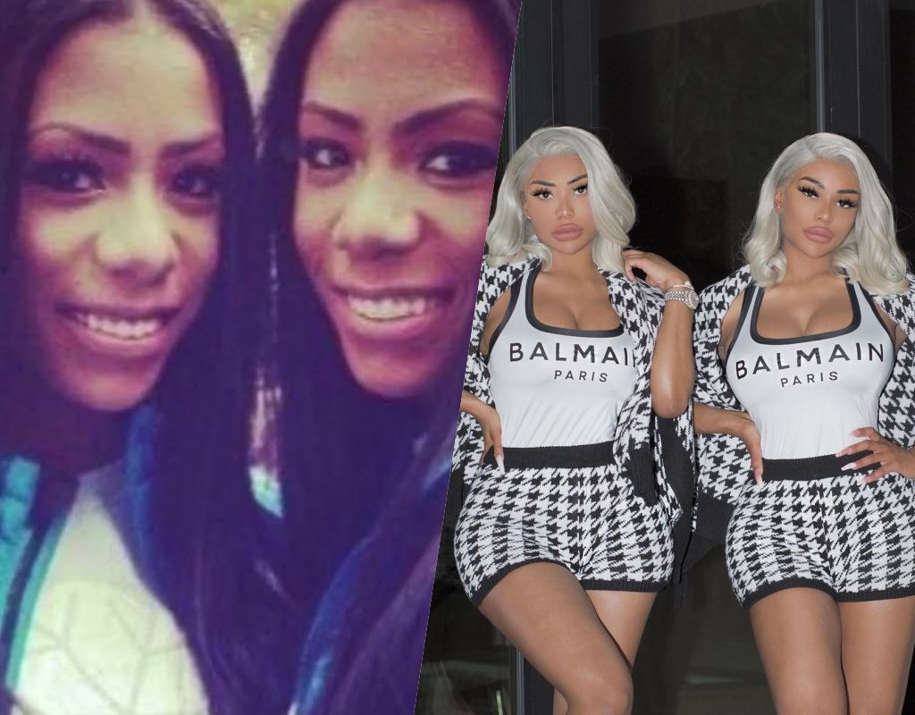 clermont twins before and after