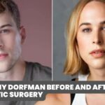 tommy dorfman Before And After Plastic Surgery
