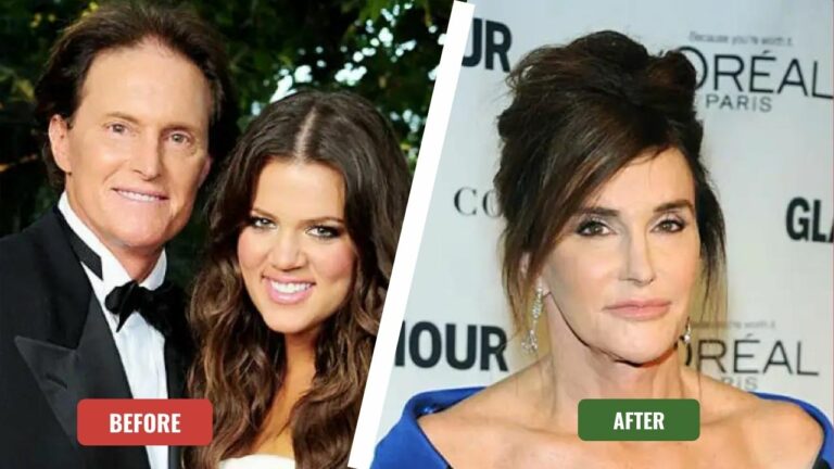 Caitlyn Jenner Before And After Plastic Surgery What Surgery Has Caitlyn