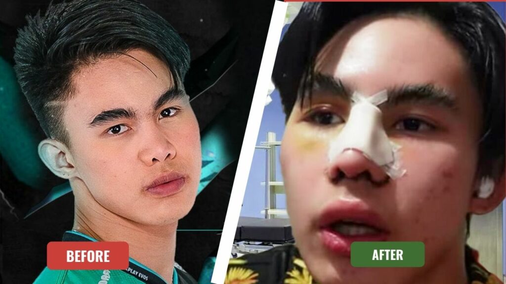 Renejay Reveals 'New Face' After Rhinoplasty
