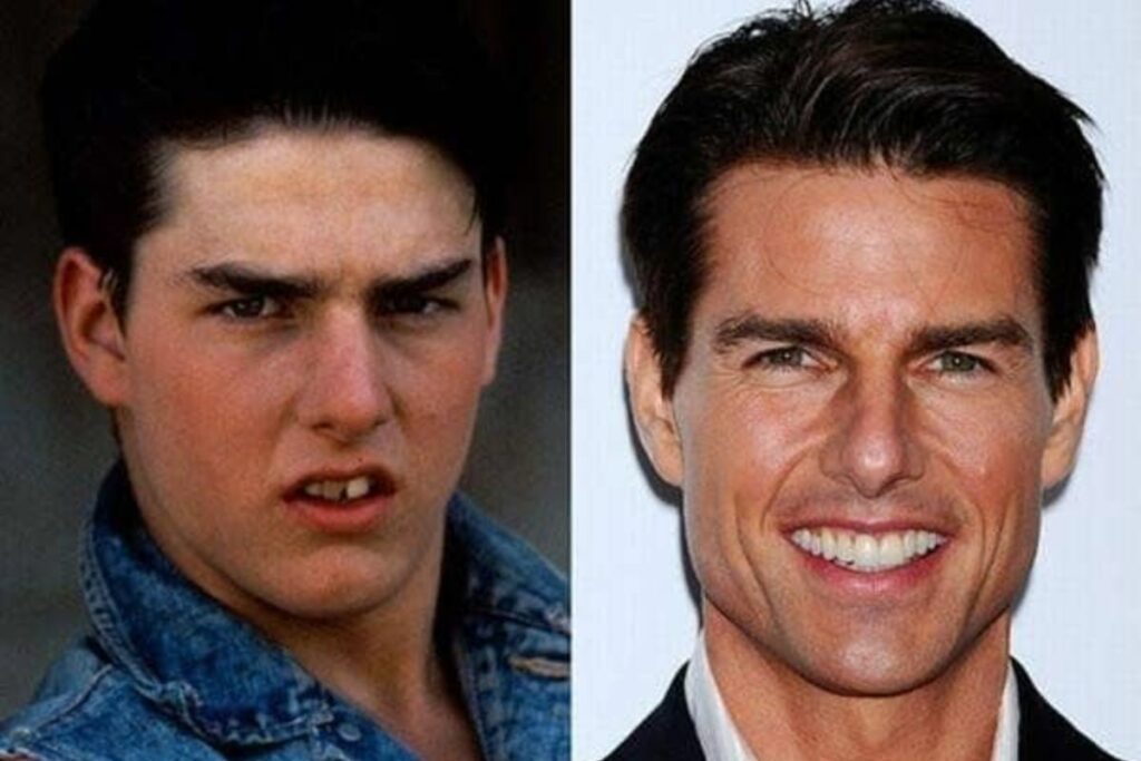 Tom Cruise Teeth Before And After Photos