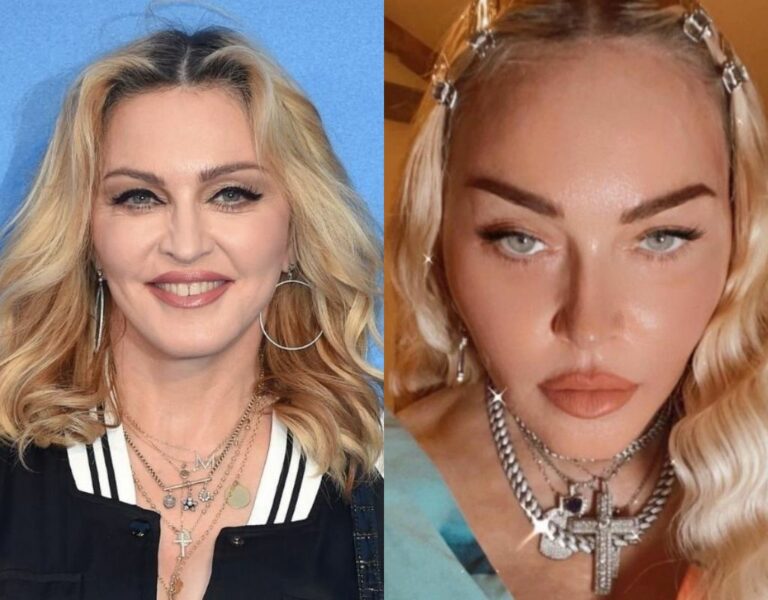 Madonna Before & After Plastic Surgery Full Transformation Jouney