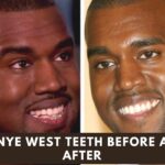 kanye west teeth before and after