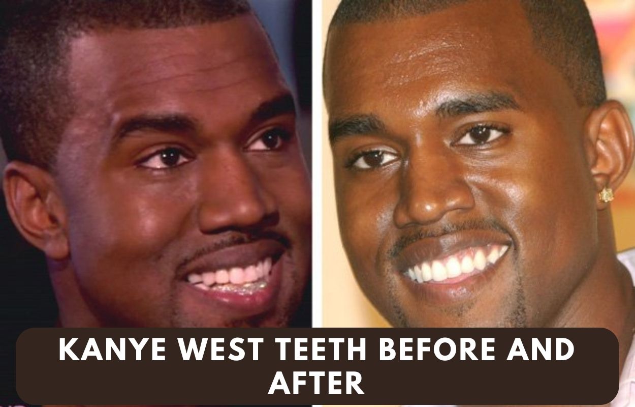 kanye west teeth before and after