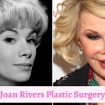 Joan Rivers Plastic Surgery