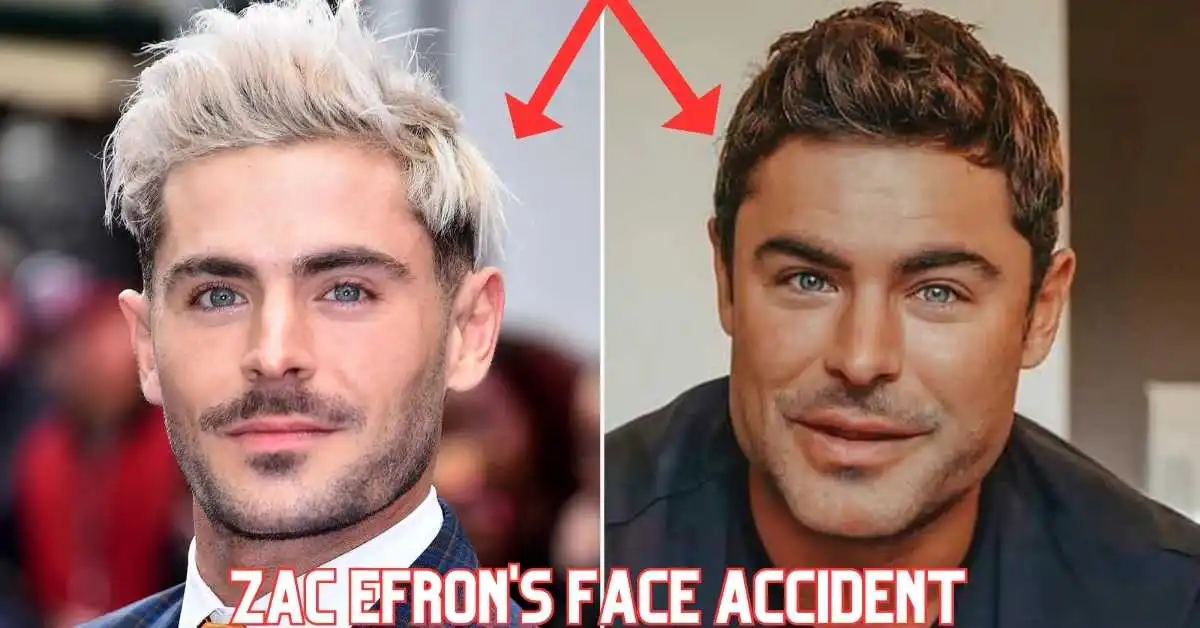 Zac Efron's Face Accident
